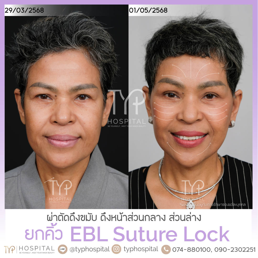 รีวิวยกคิ้ว EBL - TYP HOSPITAL