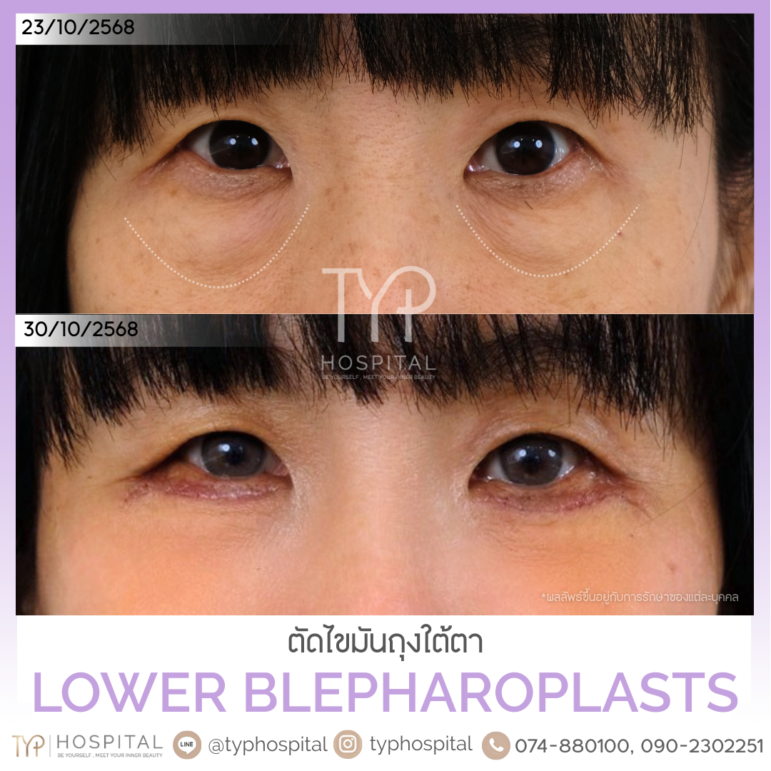 รีวิวตัดถุงใต้ตา - TYP Hospital