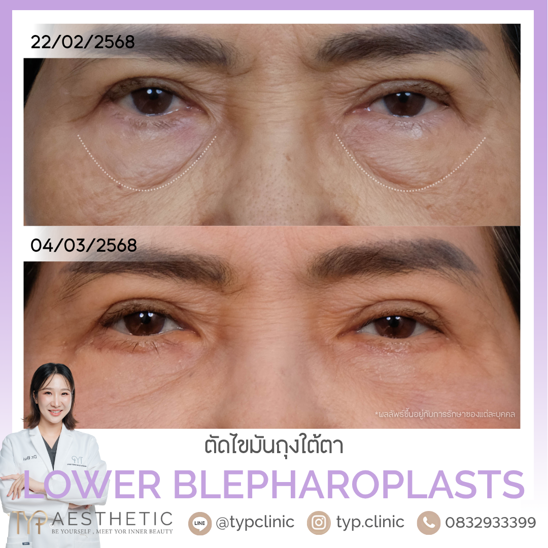 รีวิวตัดถุงใต้ตา - TYP Hospital