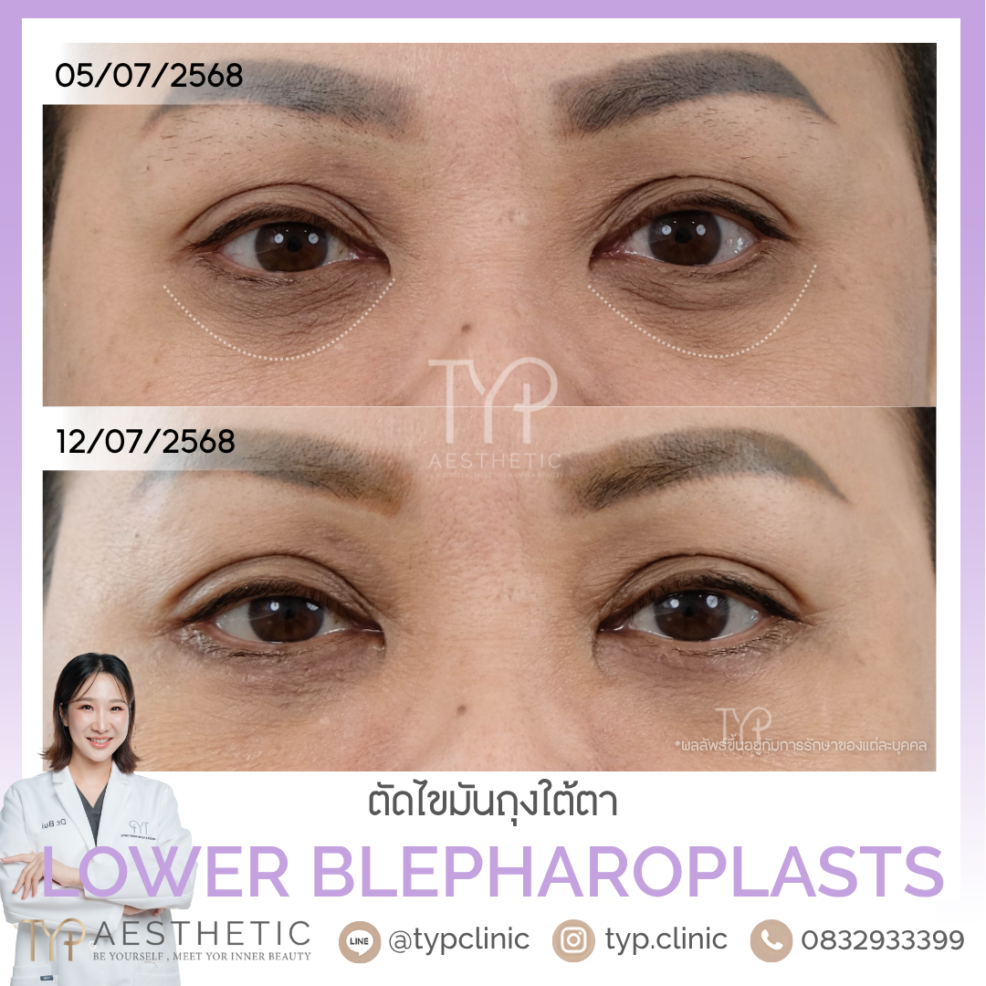 รีวิวตัดถุงใต้ตา - TYP Hospital