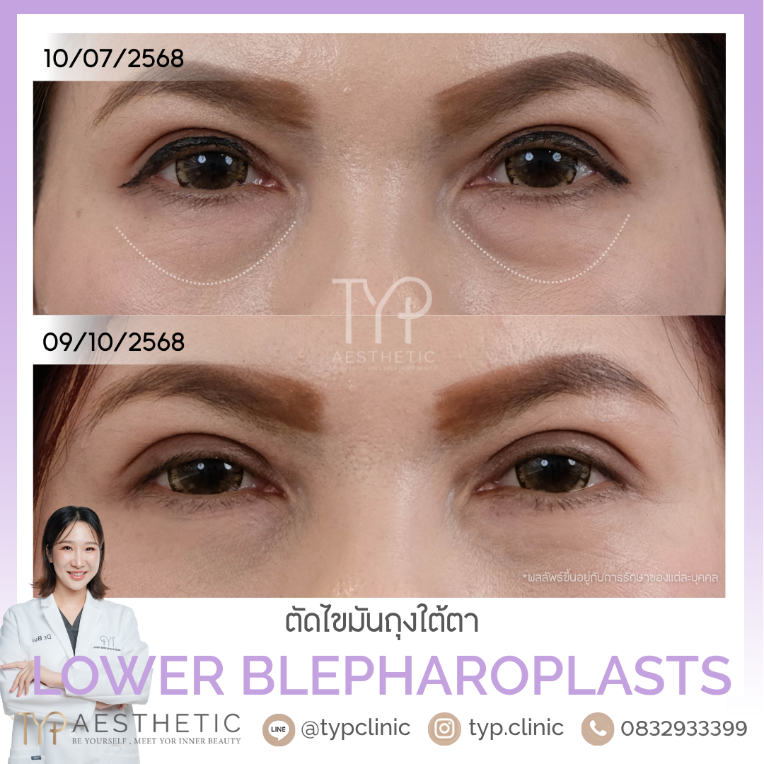 รีวิวตัดถุงใต้ตา - TYP Hospital